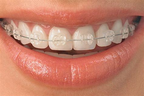 metal or ceramic brackets|ceramic ortho brackets.